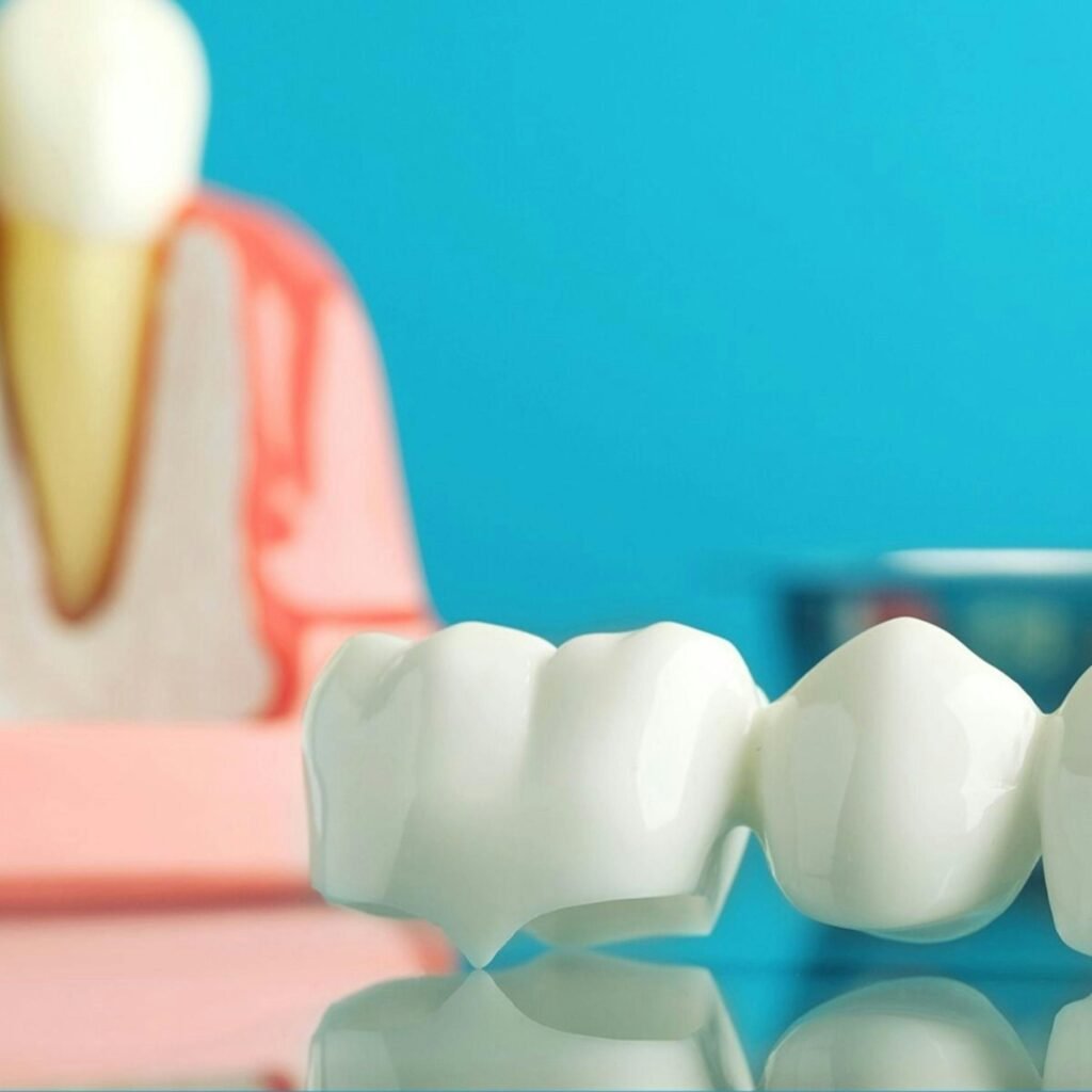 Dental crown model showing porcelain crown placement
