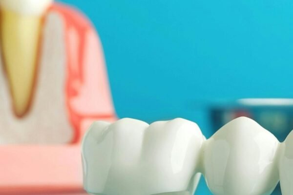 Dental crown model showing porcelain crown placement