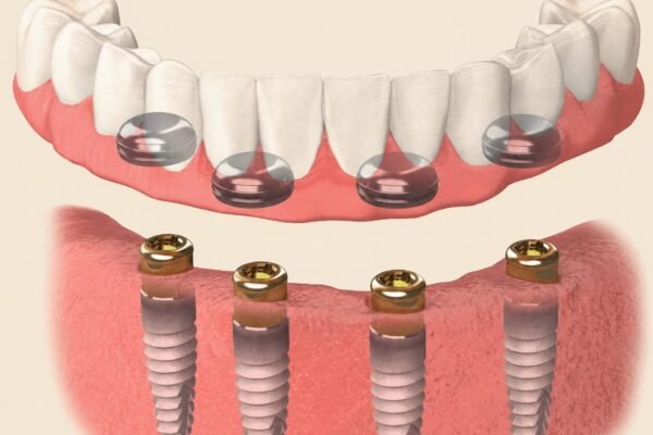 Dental implant supported denture illustration