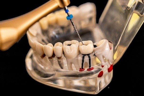 Endodontic Dentistry — anatomical illustration