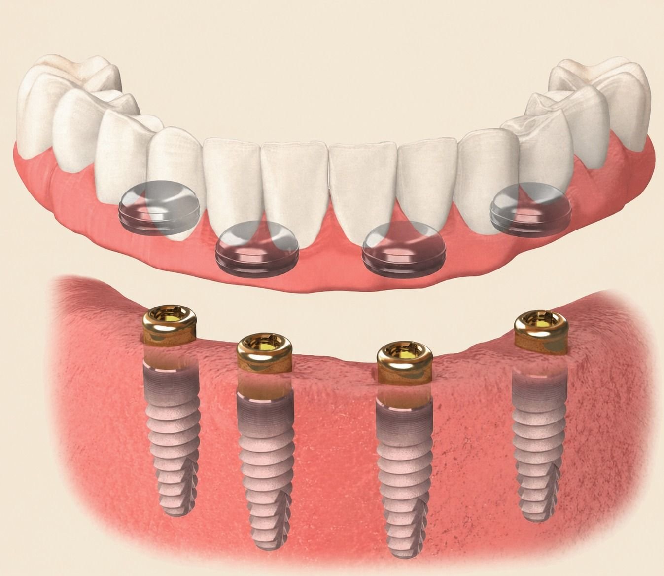 Implant Overdenture — anatomical illustration