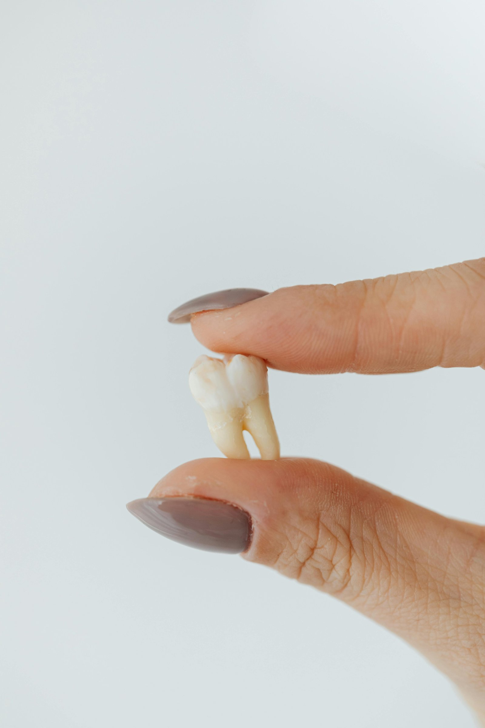 Wisdom Teeth Extractions — anatomical illustration