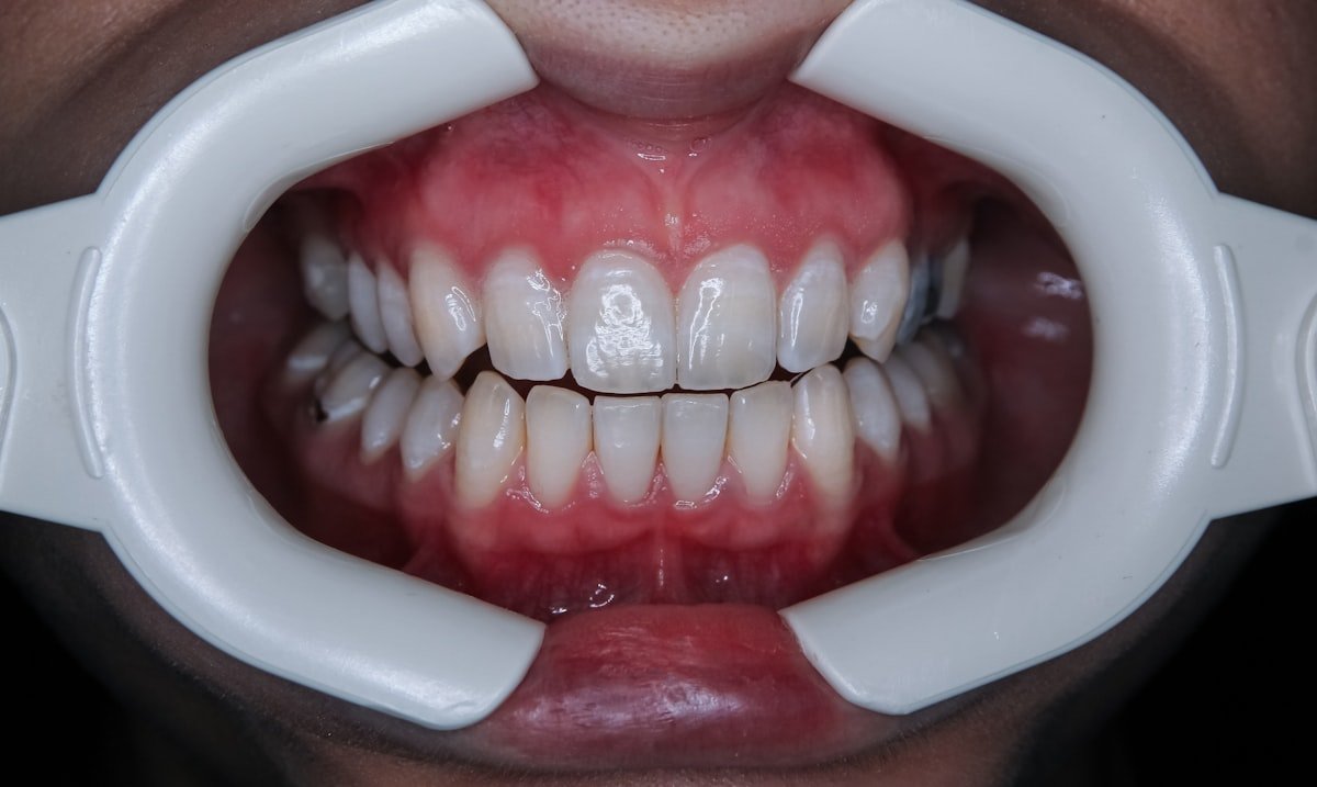 Close-up of a healthy, natural-looking smile after restoration
